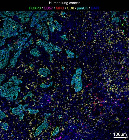 Human lung cancer